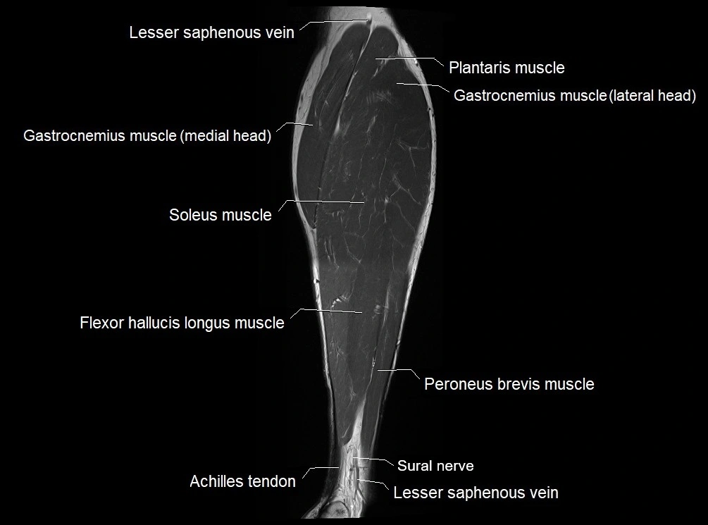 MRI 3T leg (tibia & fibula) labelled coronal cross sectional anatomy image 24.webp